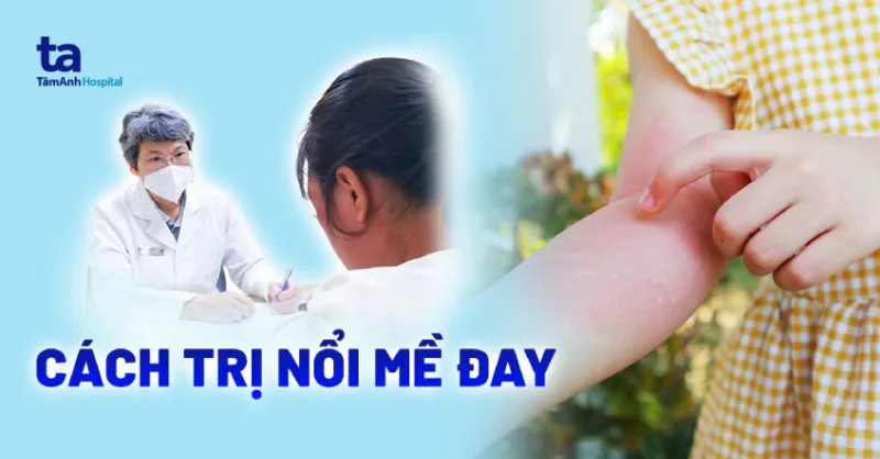 cách trị nổi mề đay tại nhà